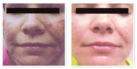 acne-treatment4